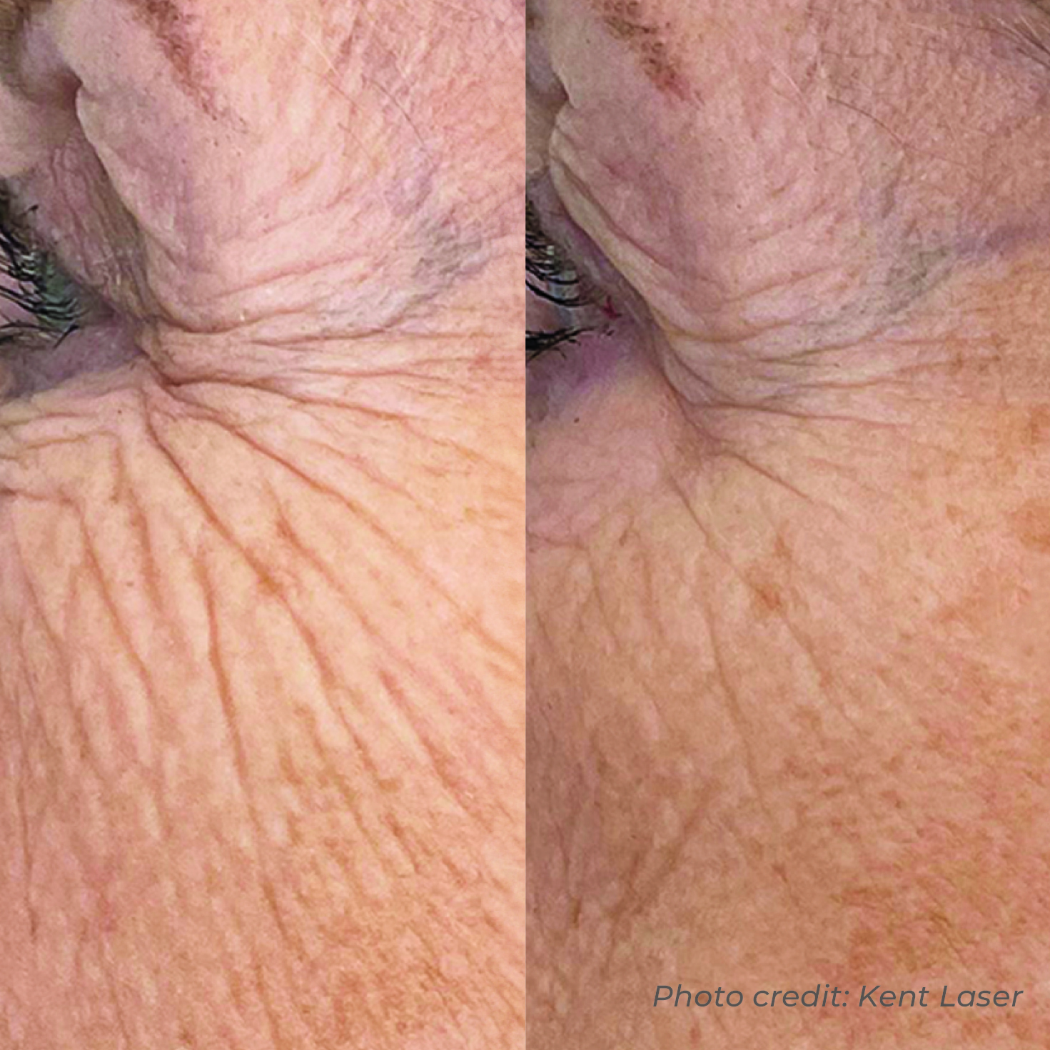 Dermaforce crow's feet before and after — smoother, softer eye area