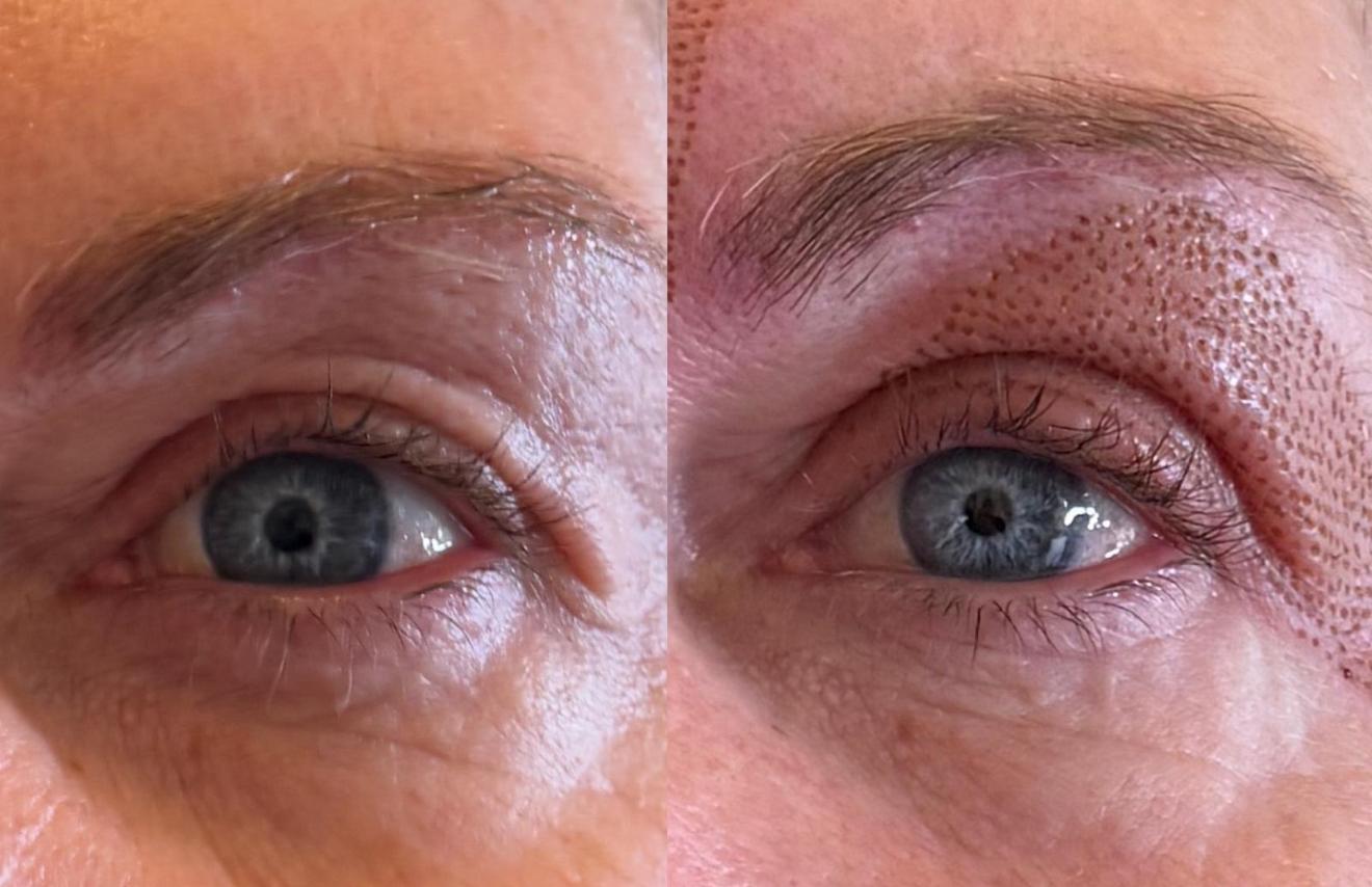 Plasma fibroblast close-up — treated upper eyelid showing the plasma dot pattern immediately after treatment