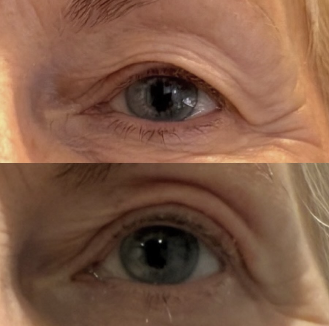 Plasma fibroblast non-surgical blepharoplasty before and after — tighter, lifted upper eyelid