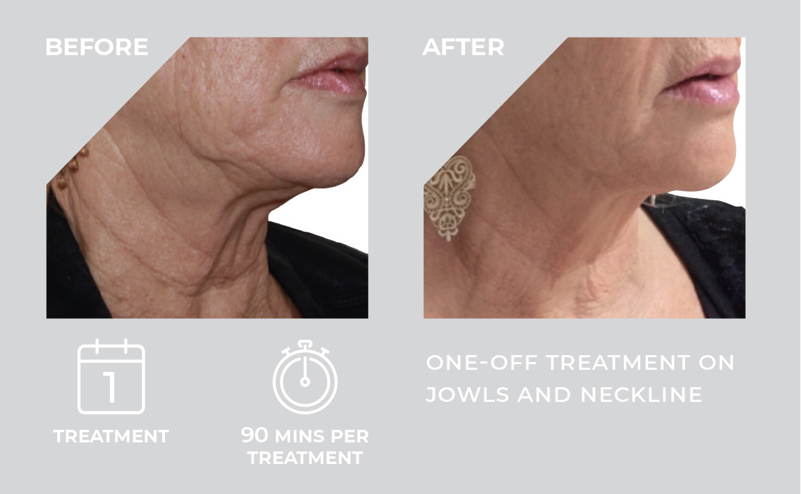 HIFU 3D treatment results — before and after comparison