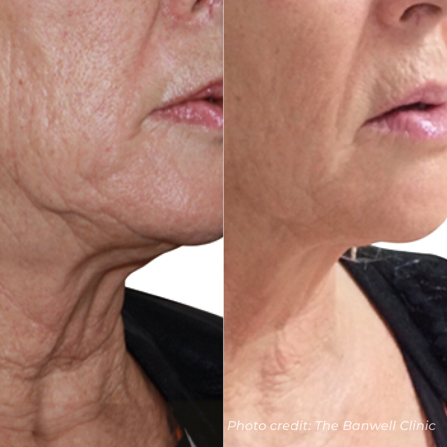 HIFU lower face before and after — treatment two
