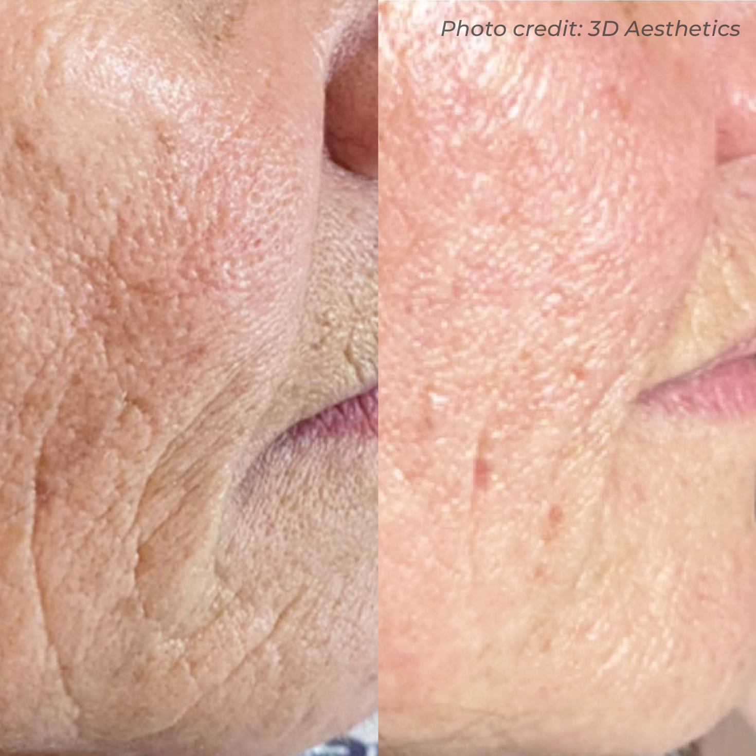 Dermaforce cheek and mouth area before and after — three sessions