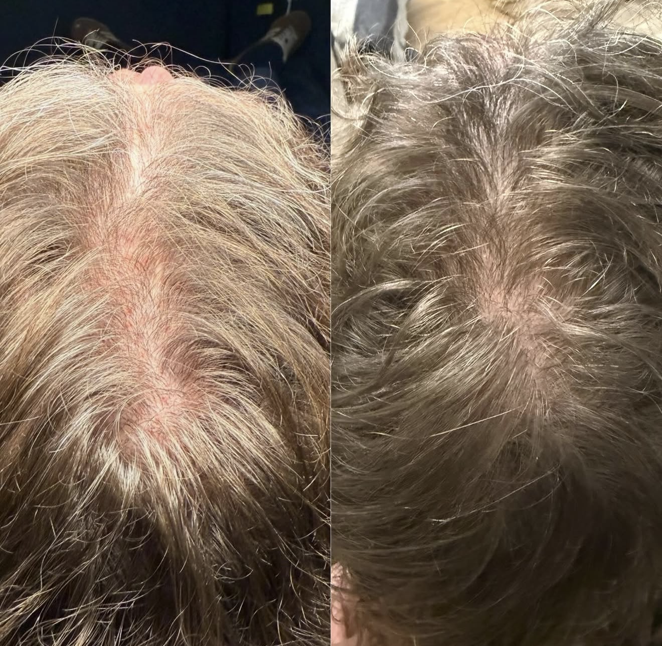Hair restoration before and after — improved scalp coverage and density at the crown
