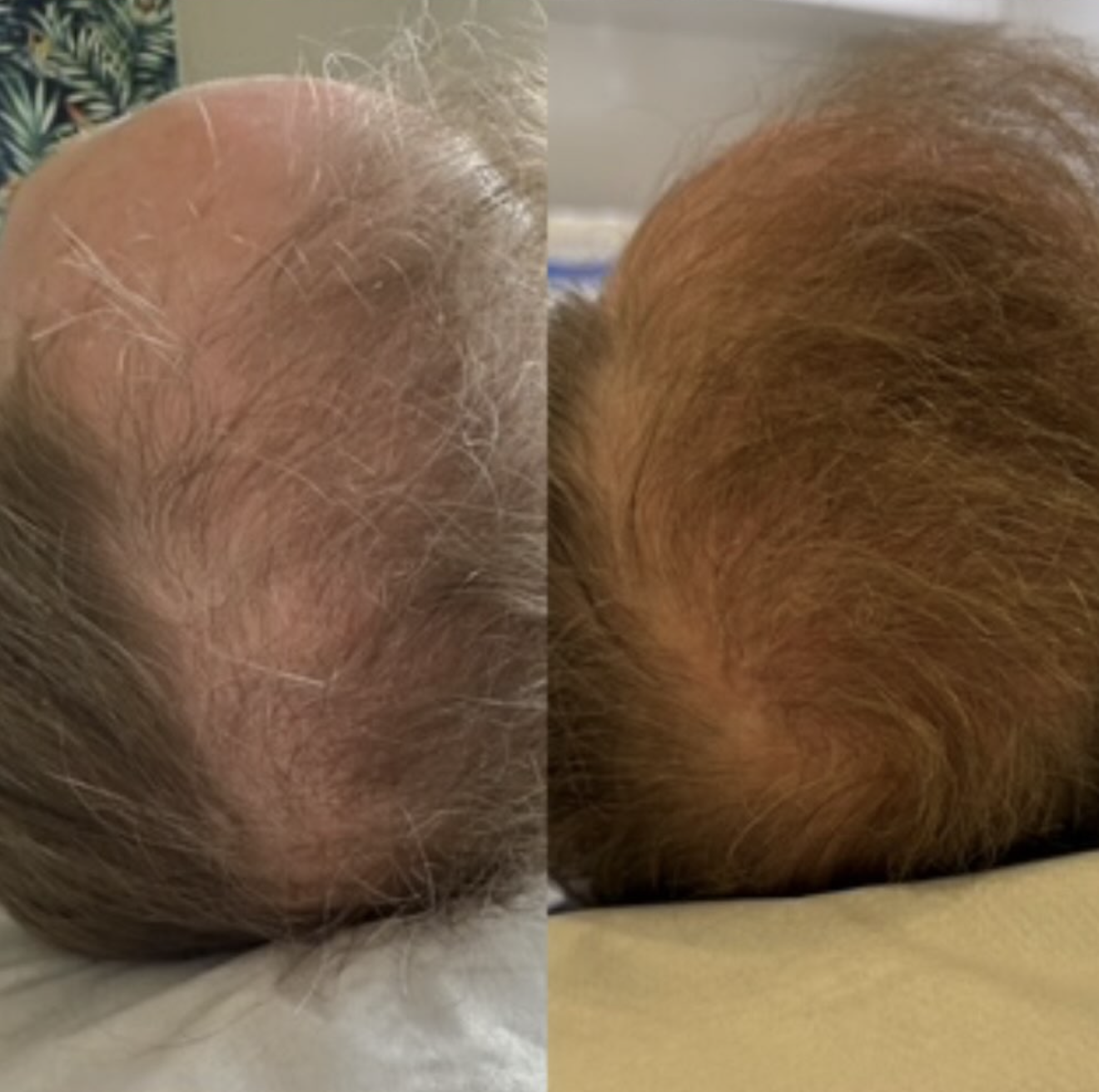 Hair restoration before and after — regrowth and thicker coverage on thinning crown