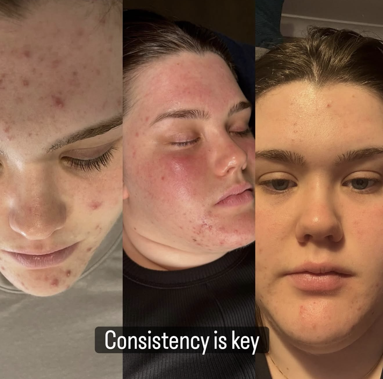 Bespoke skincare progression — clearer, calmer, more even complexion over time