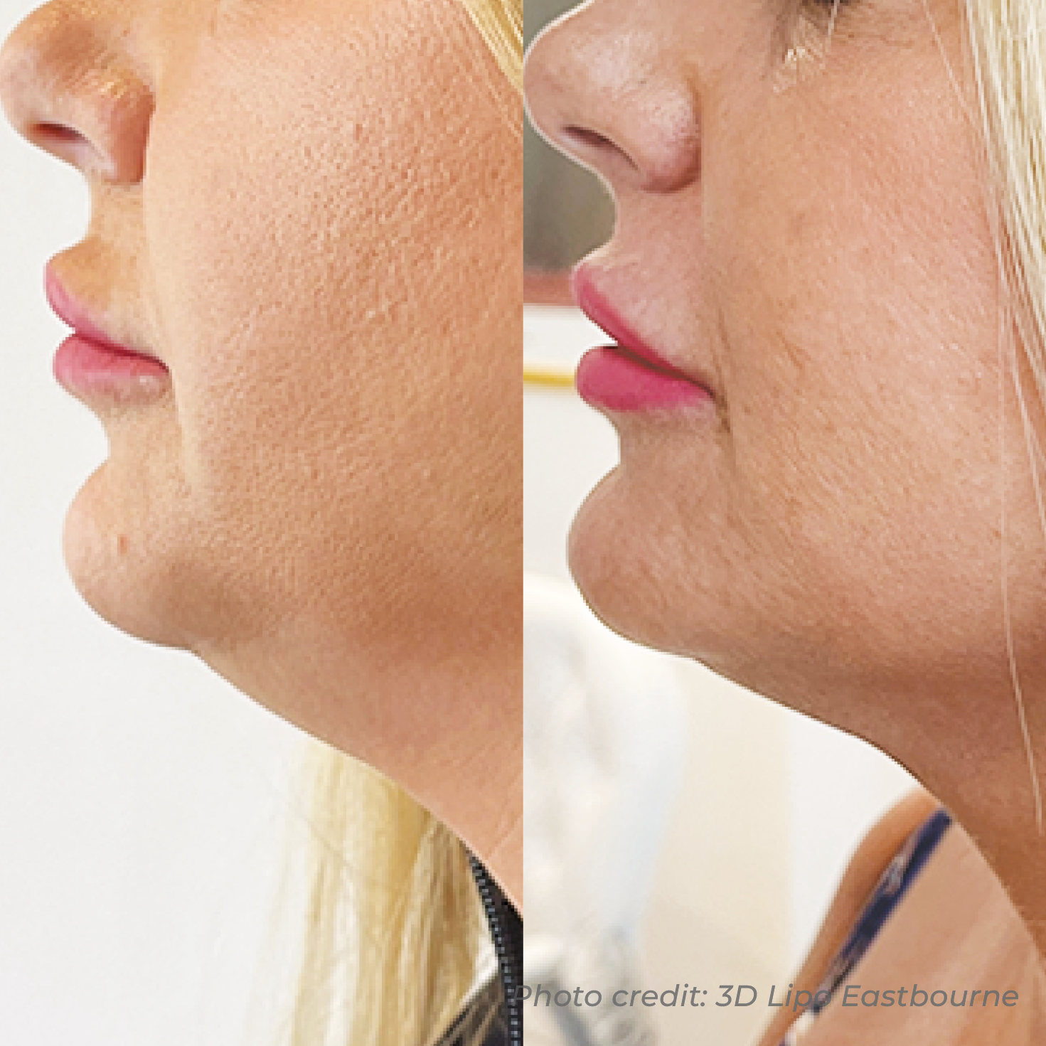 HIFU face and neck before and after — treatment one